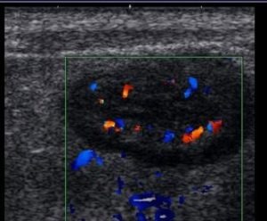 Wzmożone ukrwienie ściany jelit w badaniu USG dopplerowskim - choroba Crohna